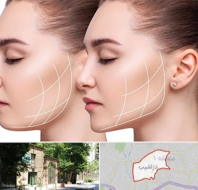 جراحی بوکال فت در دزاشیب