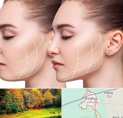 جراحی بوکال فت در کردکوی