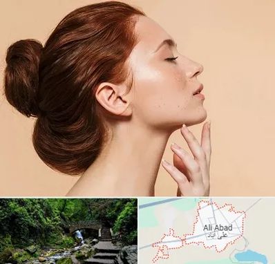 جراحی غبغب در علی آباد کتول