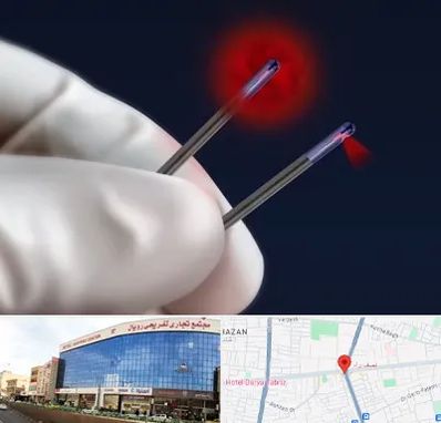 جراحی سینه با لیزر در نصف راه تبریز