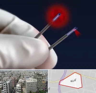 جراحی سینه با لیزر در آذری