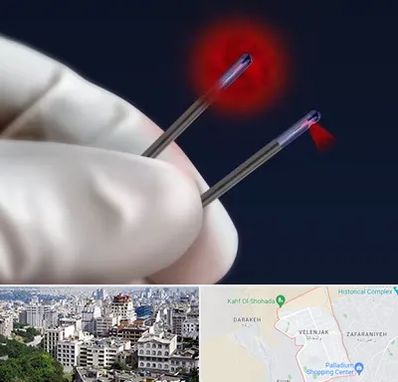 جراحی سینه با لیزر در ولنجک 