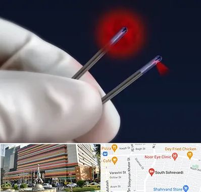 جراحی سینه با لیزر در سهروردی 