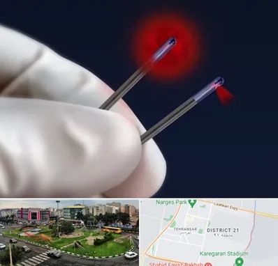 جراحی سینه با لیزر در تهرانسر 