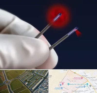 جراحی سینه با لیزر در الهیه مشهد