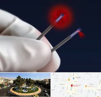 جراحی سینه با لیزر در هفت حوض 