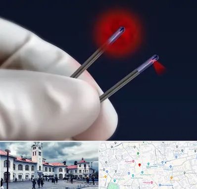 جراحی سینه با لیزر در میدان شهرداری رشت