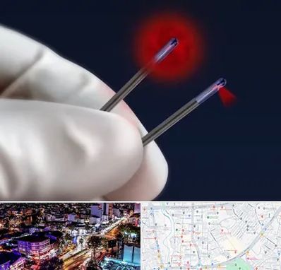 جراحی سینه با لیزر در منظریه رشت