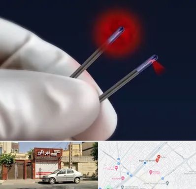 جراحی سینه با لیزر در باجک قم