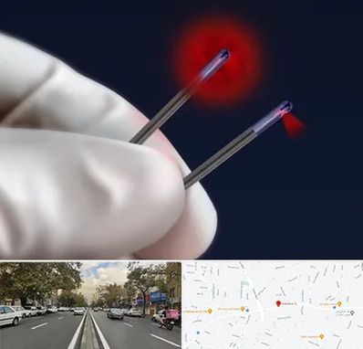 جراحی سینه با لیزر در دولت