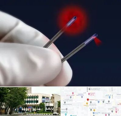 جراحی سینه با لیزر در طالقانی 