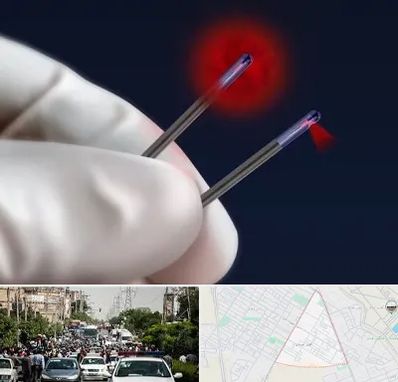 جراحی سینه با لیزر در سیدی مشهد