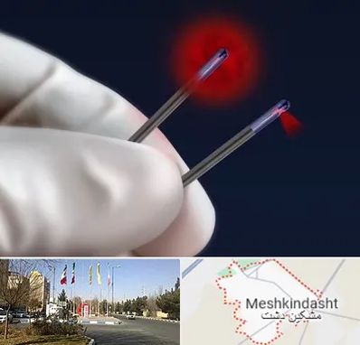 جراحی سینه با لیزر در مشکین دشت