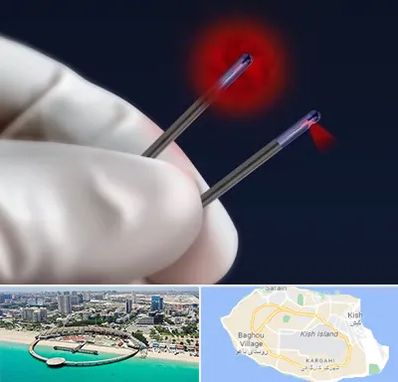 جراحی سینه با لیزر در کیش