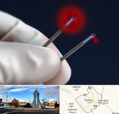 جراحی سینه با لیزر در تایباد