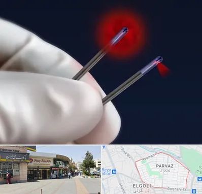 جراحی سینه با لیزر در پرواز تبریز