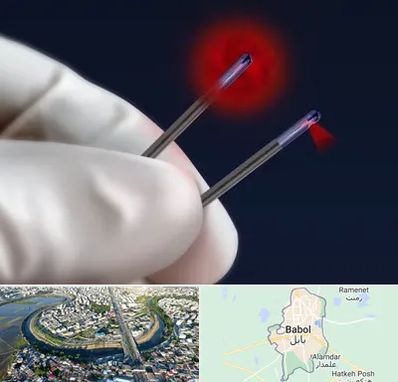 جراحی سینه با لیزر در بابل