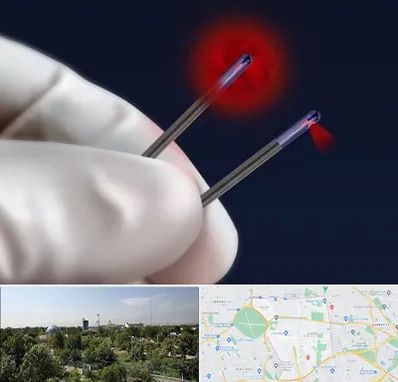 جراحی سینه با لیزر در منطقه 16 تهران 