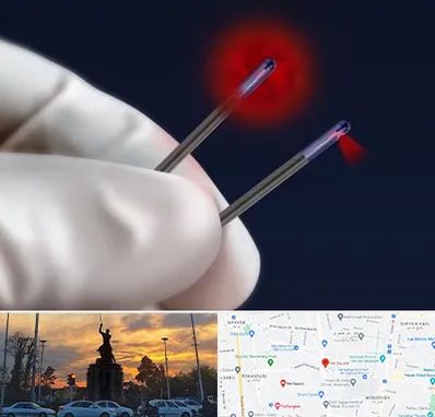 جراحی سینه با لیزر در میدان حر 