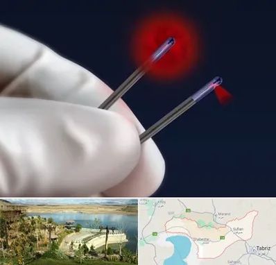 جراحی سینه با لیزر در شبستر