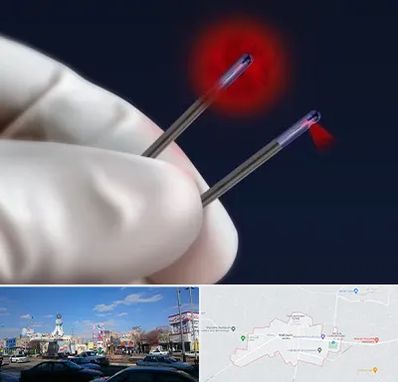 جراحی سینه با لیزر در ماهدشت کرج