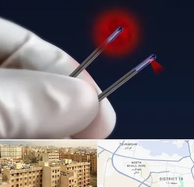 جراحی سینه با لیزر در جنوب غرب تهران