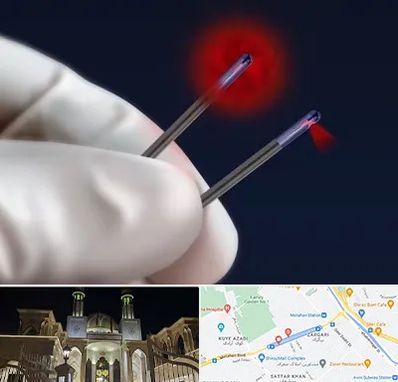 جراحی سینه با لیزر در زرگری شیراز