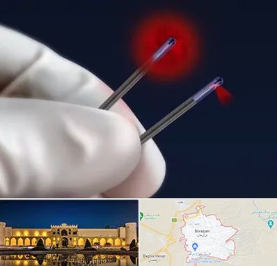 جراحی سینه با لیزر در برازجان