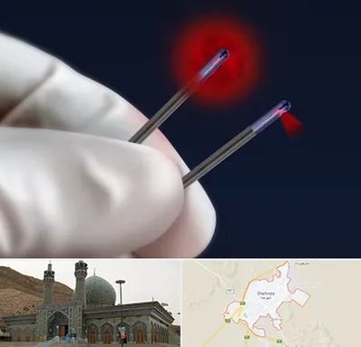 جراحی سینه با لیزر در شهرضا