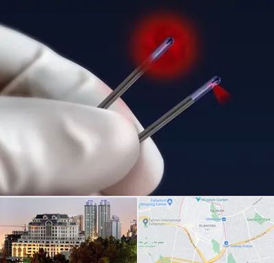 جراحی سینه با لیزر در فرشته 