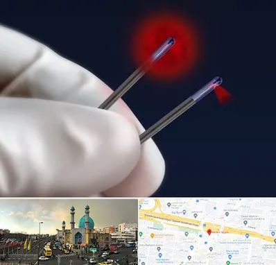 جراحی سینه با لیزر در رسالت 