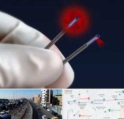 جراحی سینه با لیزر در پیروزی 