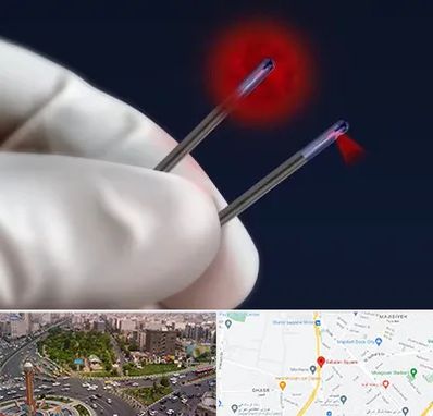 جراحی سینه با لیزر در سبلان 