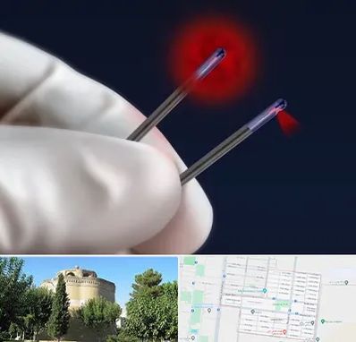 جراحی سینه با لیزر در مرداویج اصفهان