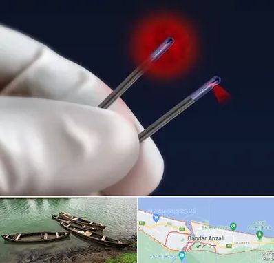 جراحی سینه با لیزر در بندر انزلی