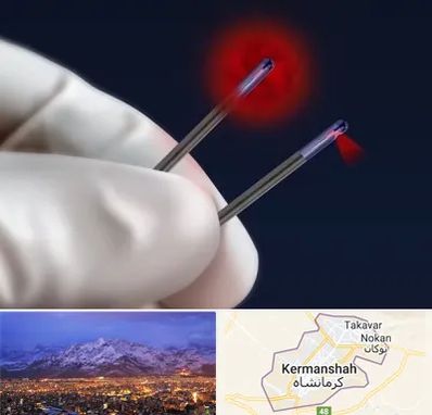 جراحی سینه با لیزر در کرمانشاه