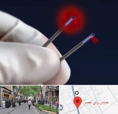 جراحی سینه با لیزر در ولیعصر شهریار