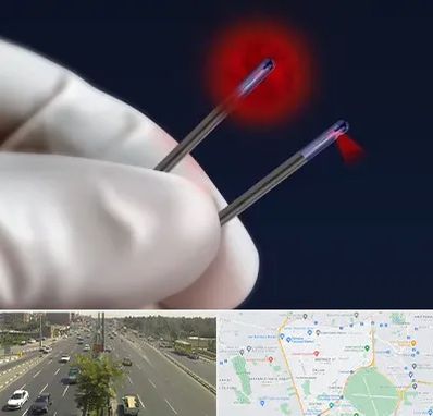 جراحی سینه با لیزر در منطقه 17 تهران 