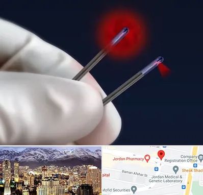 جراحی سینه با لیزر در جردن 