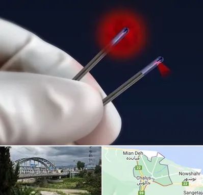 جراحی سینه با لیزر در چالوس