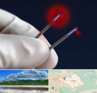 جراحی سینه با لیزر در مرند