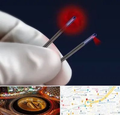 جراحی سینه با لیزر در میدان ولیعصر 