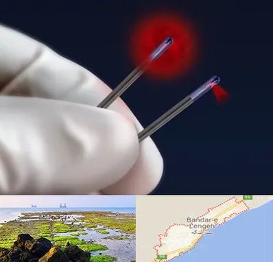 جراحی سینه با لیزر در بندرلنگه