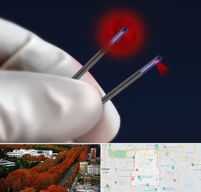 جراحی سینه با لیزر در منطقه 6 تهران 