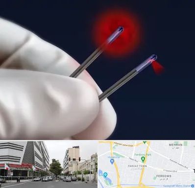 جراحی سینه با لیزر در بلوار فردوس 