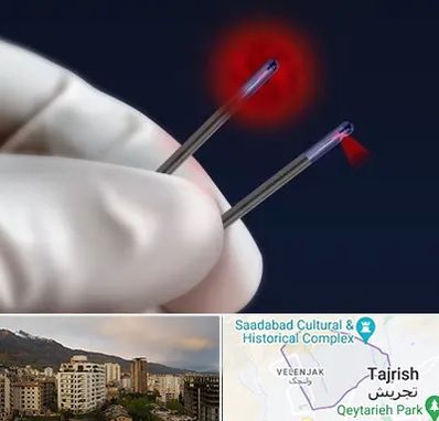 جراحی سینه با لیزر در زعفرانیه 