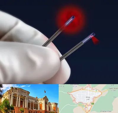 جراحی سینه با لیزر در خوی