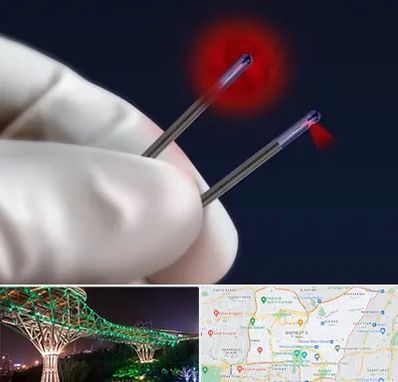 جراحی سینه با لیزر در منطقه 3 تهران 