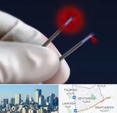 جراحی سینه با لیزر در قیطریه 