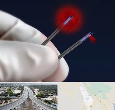 جراحی سینه با لیزر در اندیمشک